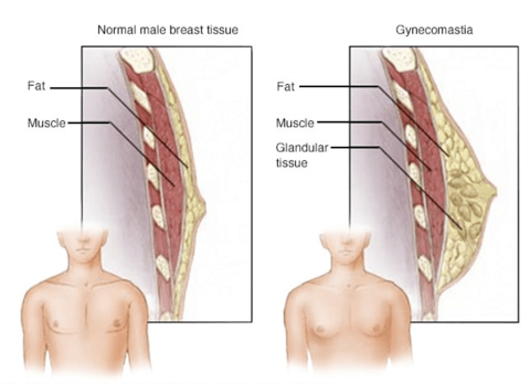 What is Gynecomastia? Why it Develops and What You Can Do About It